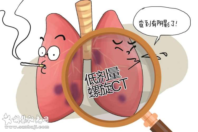 香港“老戏骨”因肺癌去世 专家称早诊早治者治愈率可达90%以上  高危人群需每年做一次肺部CT ...